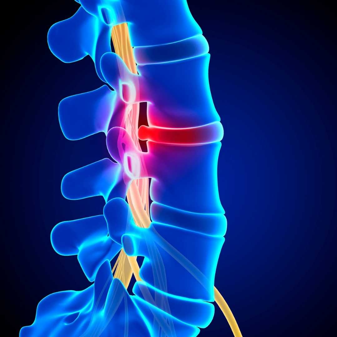 Diagnosing an SCI: An image of a person's spine.
