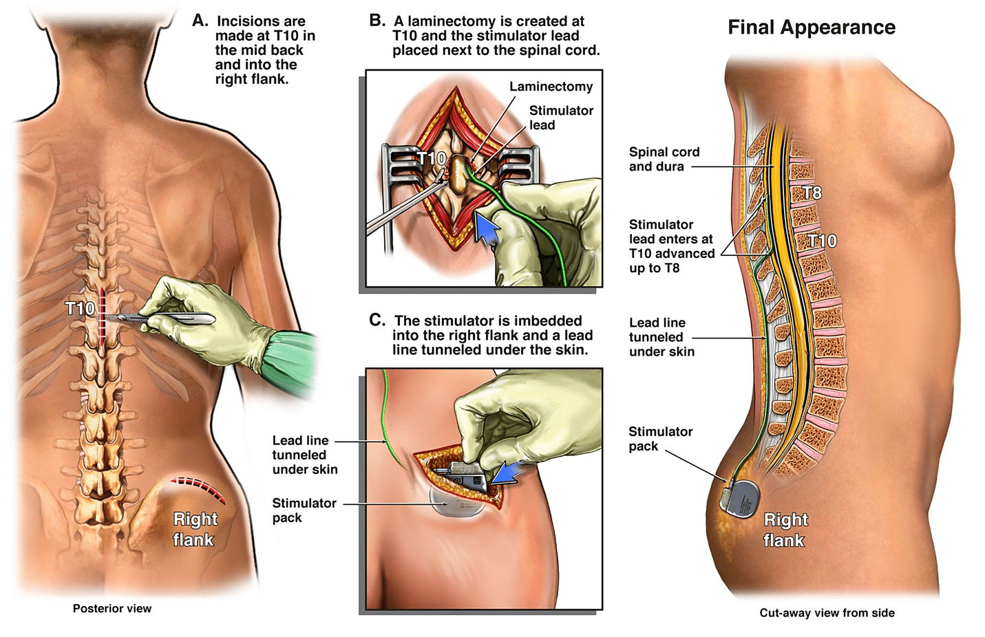 medical graphic visualizing epidural stimulation